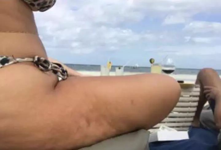 (P) Corecția și îndepărtarea ridurilor, regina procedurilor estetice