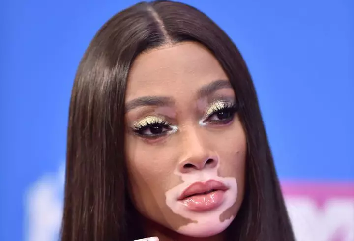 2 remedii rapide pentru arsurile solare