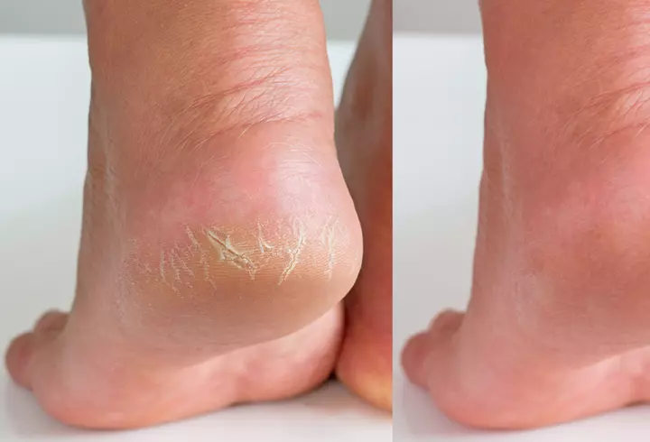 Îngrijirea tenului uscat. Cum să păstrezi hidratarea mai mult timp