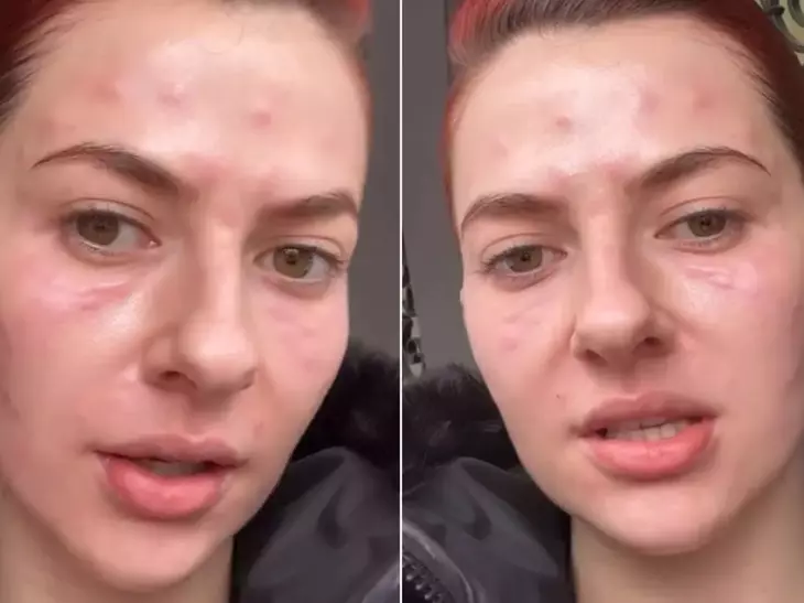 Lidia Buble, imagini îngrijorătoare. Cântăreața a apărut cu pielea umflată și roșie: „Am fața amorțită”. Ce a pățit