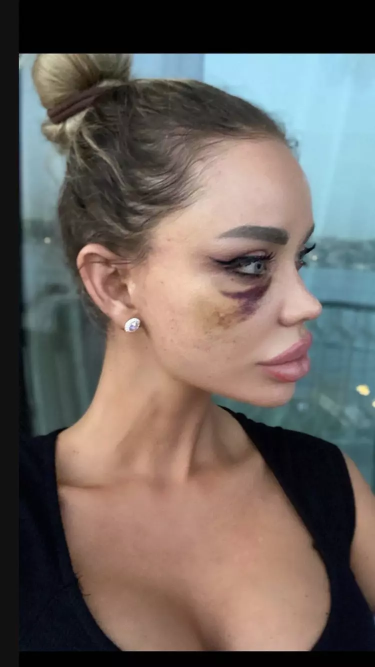 Bianca Drăgușanu bătută (8)