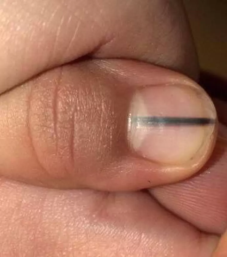 Dacă ai semnul acesta pe unghie trebuie să mergi urgent la medic