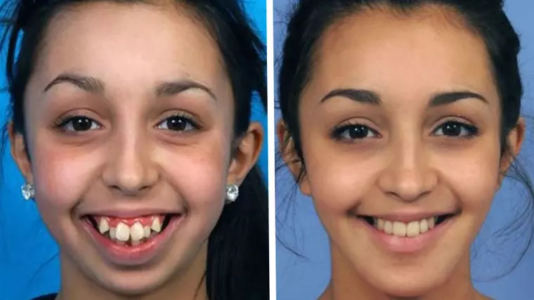 inainte si dupa operatie