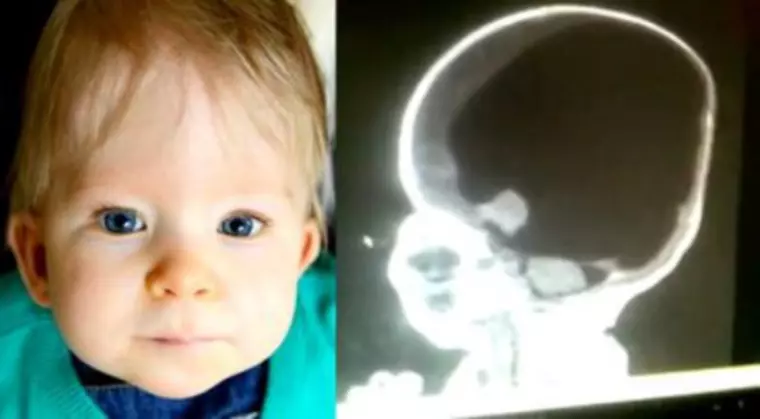 Băiețelul născut fără creier a împlinit șase ani. Cum a reușit să supraviețuiască