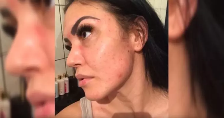 Andreea Mantea, probleme grave cu acneea: "Am ajuns să-mi dau și cu mir pe față"