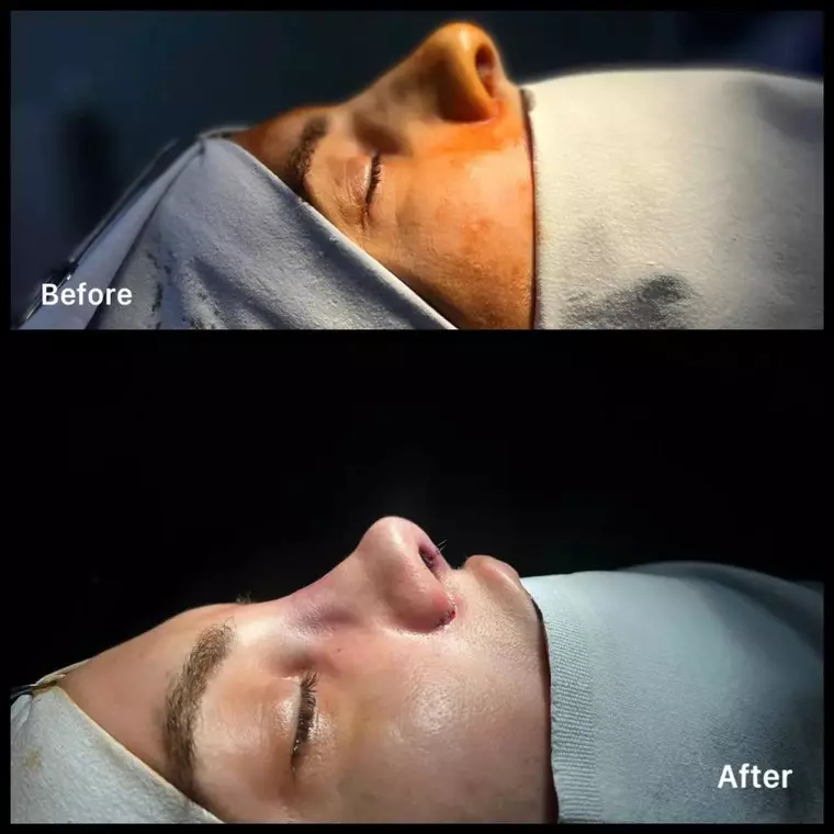 Când este considerată rinoplastia necesitate medicală şi când este moft?