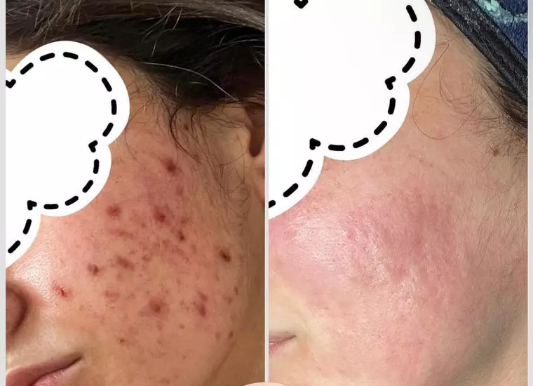 De la problemele cu acneea, la rezultate spectaculoase: Tratamente personalizate pentru fiecare tip de ten la clinica Zeus Med by Dr. Pascal Dameh