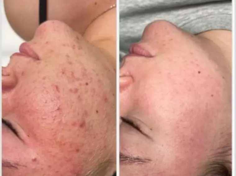 De la problemele cu acneea, la rezultate spectaculoase: Tratamente personalizate pentru fiecare tip de ten la clinica Zeus Med by Dr. Pascal Dameh