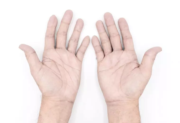 Ce semnificație are culoarea palmelor - ce probleme medicale poate indica