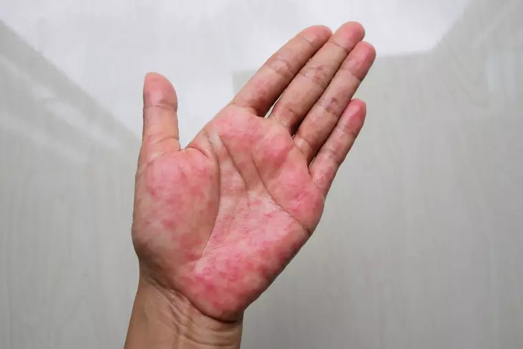 Ce semnificație are culoarea palmelor - ce probleme medicale poate indica