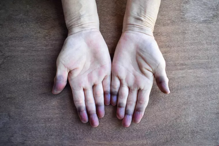 Ce semnificație are culoarea palmelor - ce probleme medicale poate indica