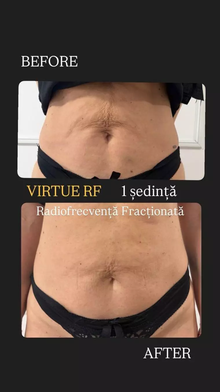 Ai slăbit, dar pielea de pe abdomen a rămas lăsată? Ce poate face radiofrecvența fracționată (Virtue RF vs Morpheus8)