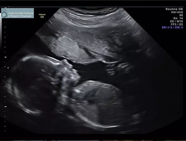 Ecografia prin care Varunie a anunțat că ea și Owen Wilson vor fi părinții unei fetițe.