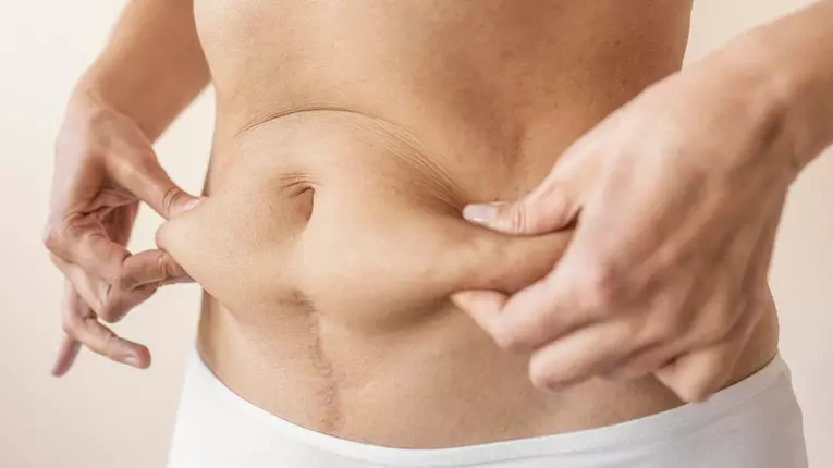 Avantajele liposucției: Când și în ce condiții să alegi această intervenție?