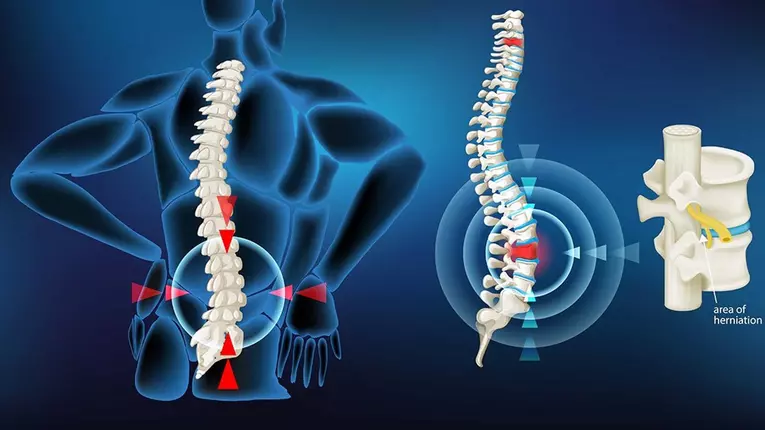 Hernia de disc: ce trebuie să știm despre această boală ?