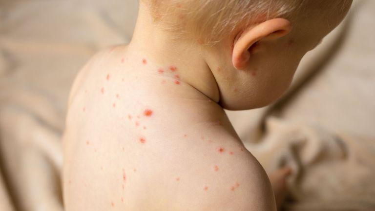 Cum Recunosti Bolile Copilariei Semne Si Simptome