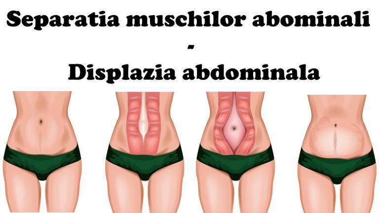 Burta dupa nastere Diastaza abdominala - Simptome si remedii