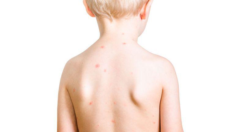 Patru copii cu rujeolă din Cluj, infectați cu noul coronavirus