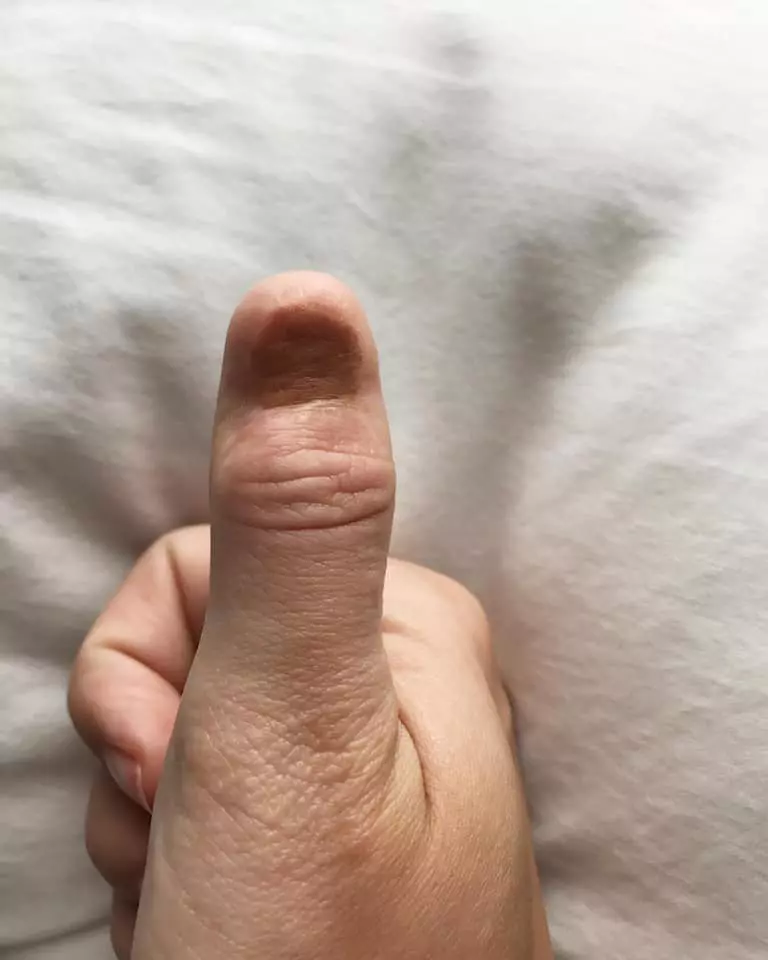 A aflat că are cancer după ce a observat un semn pe unghie (3)