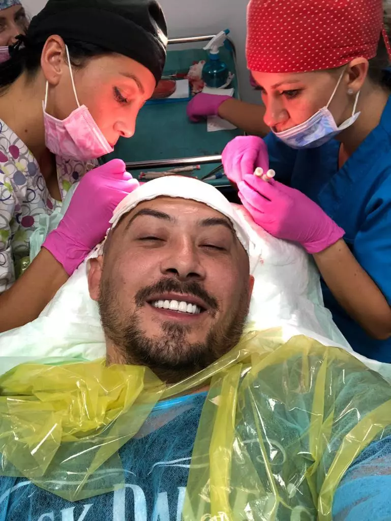 Ștefan-Stan-și-a-făcut-implant-de-păr-4