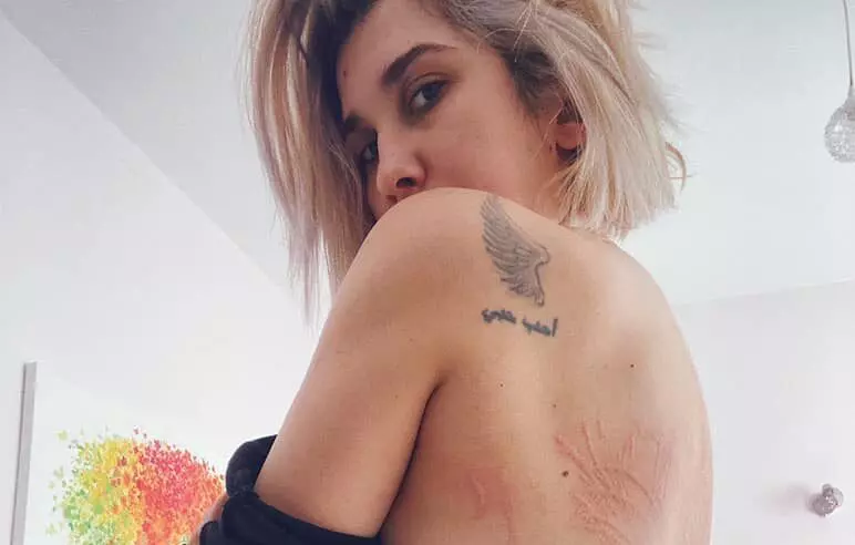 adda-boala-de-piele-e1613372598694