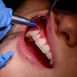 Infecțiile dentare și parodontoza: când inflamația gingiilor devine o problemă serioasă