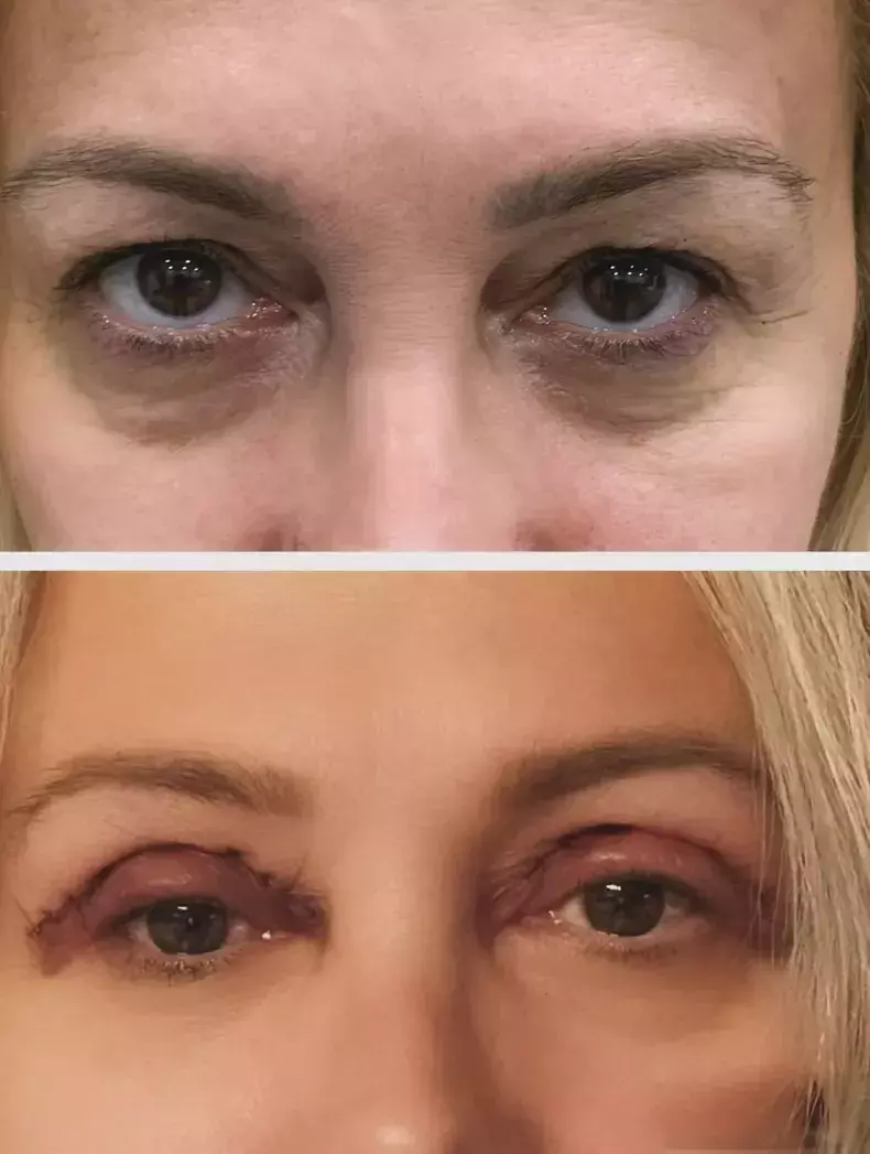 dana-savuica-belfaroplastie