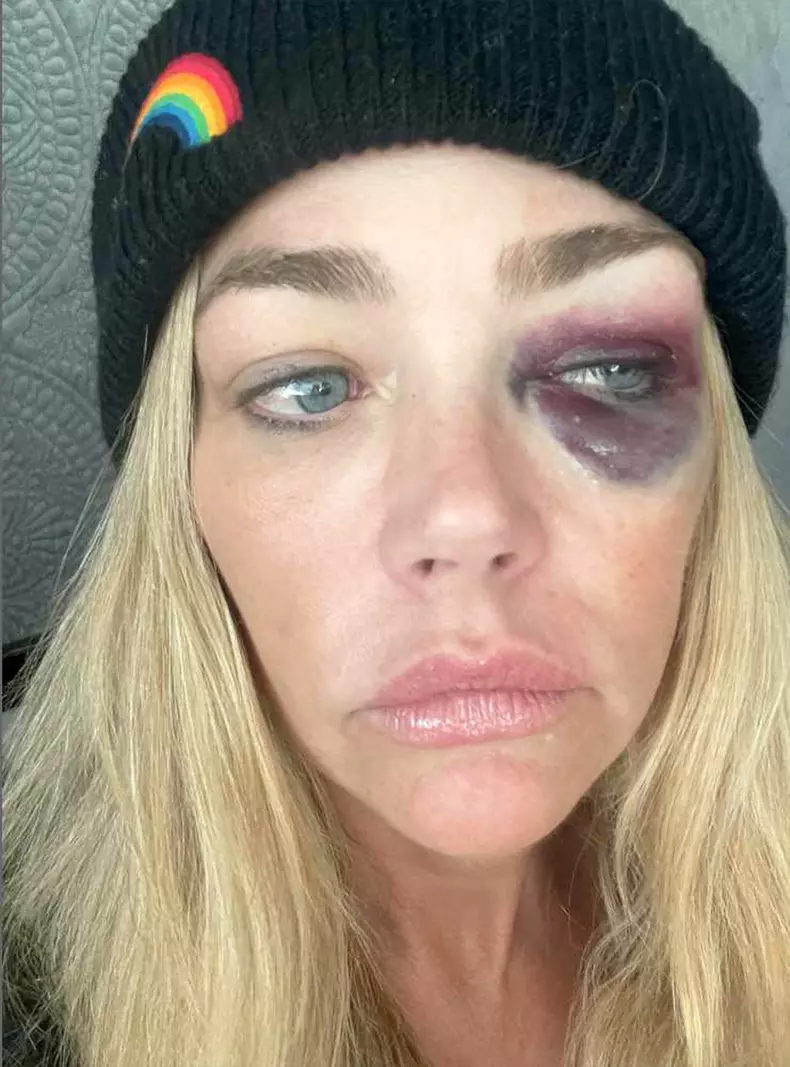 Denise Richards shares images of alleged domestic violence from estranged husband Aaron Phypers in new court documents.