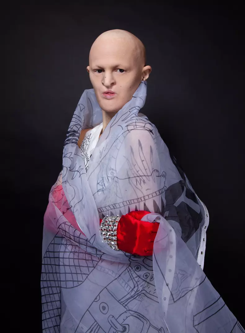 Melanie Gaydos suferă de displazie ectodermică, alopecie și e parțial oarbă, dar este un model foarte solicitat.