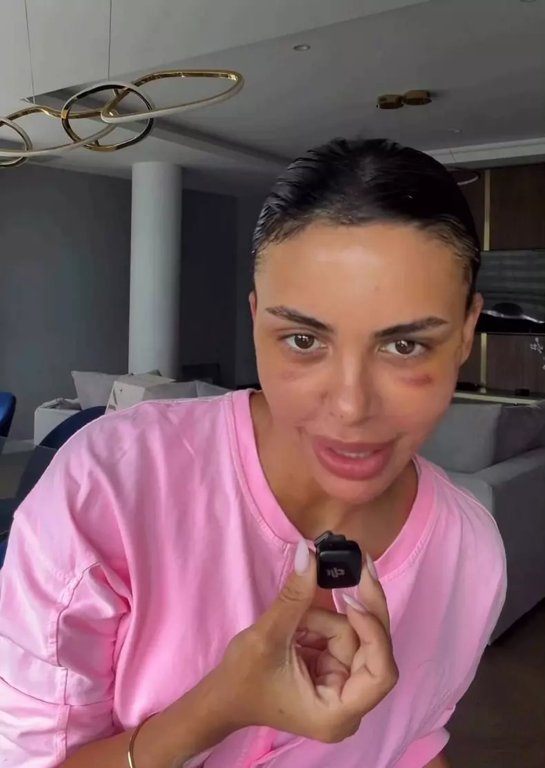Andreea Popescu vanata la ochi dupa interventie