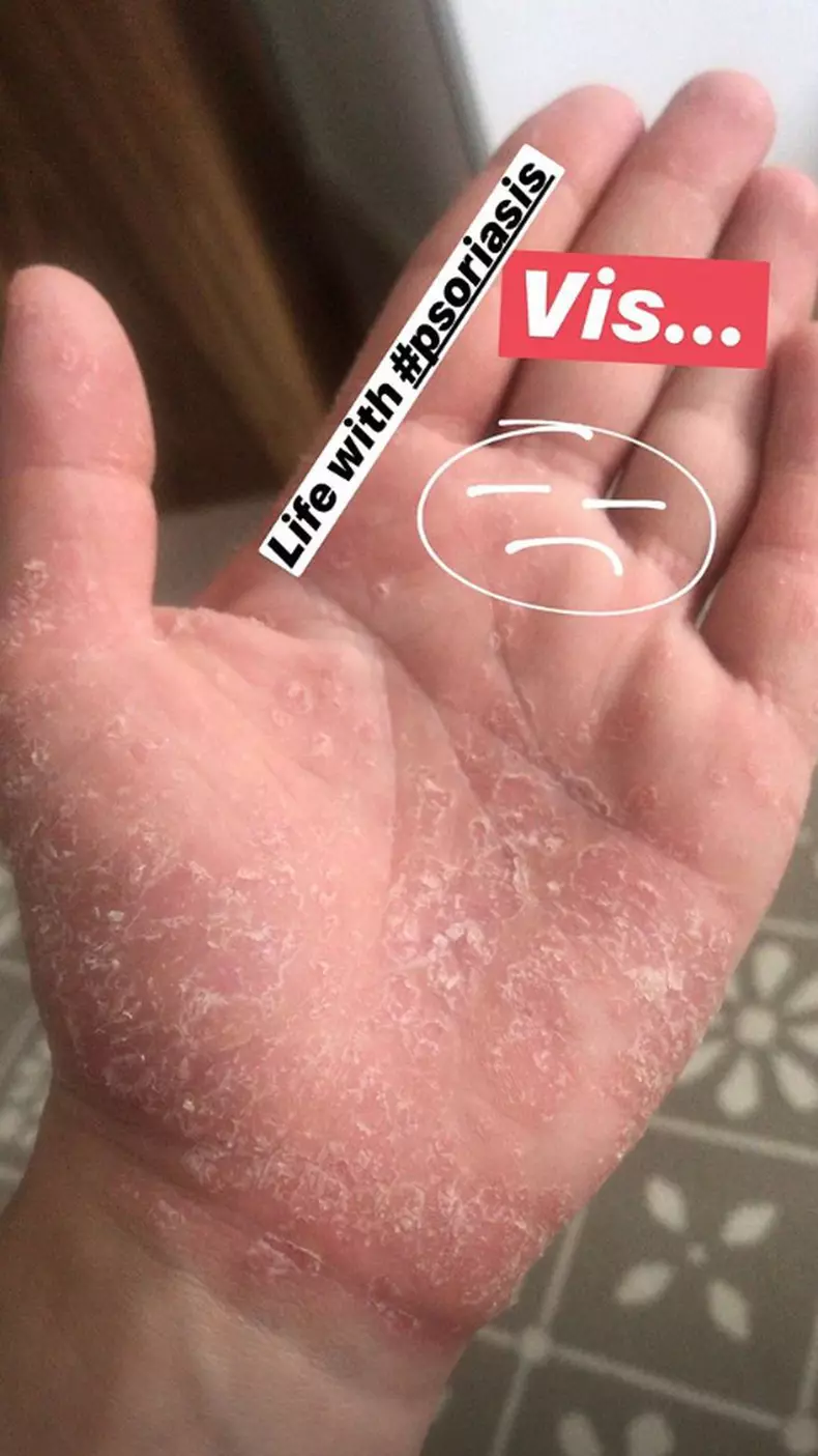 Tilly Niculae are psoriazis