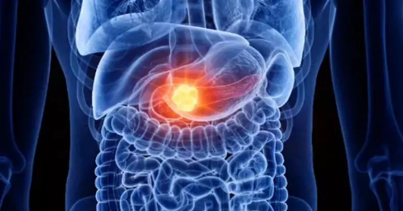 Ce au descoperit specialiștii despre cancerul pancreatic, unul dintre cele mai răspândite tipuri de cancer