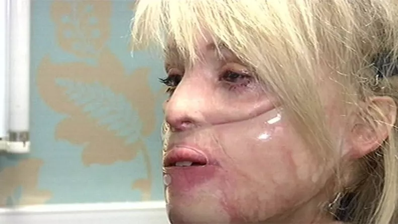 cum-arata-katie-piper-la-12-ani-dupa-ce-chipul-i-a-fost-distrus-cu-acid-sulfuric_6