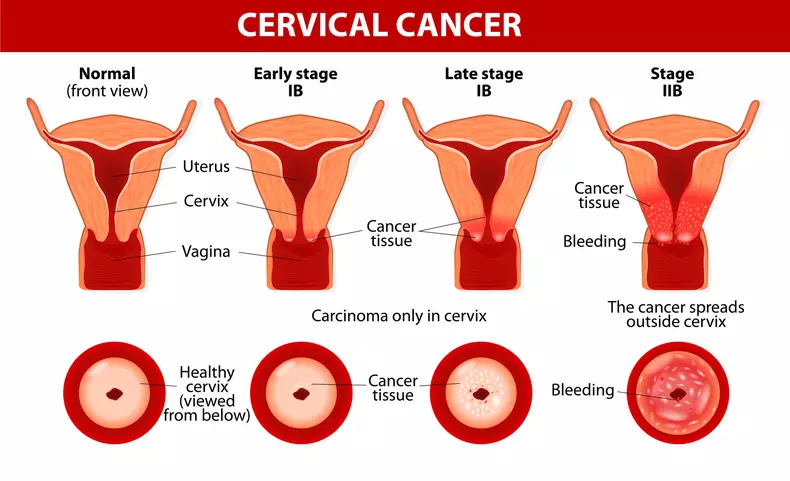 cancer de col uterin 1