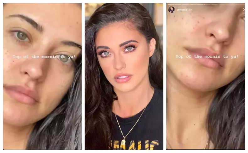 Antonia intervenție estetică la față