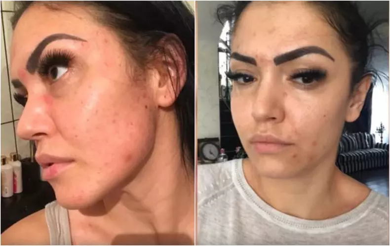 Andreea Mantea este desfigurată de acnee