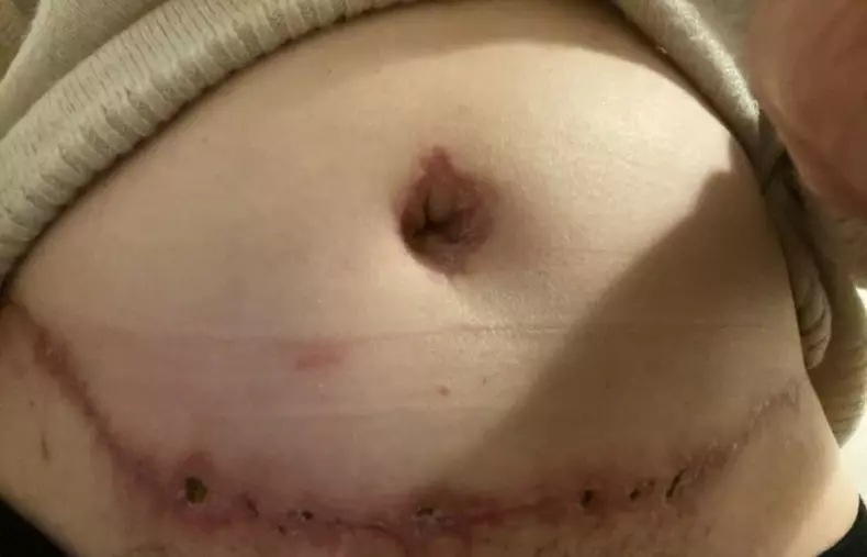 BOTCHED BOOB JOB