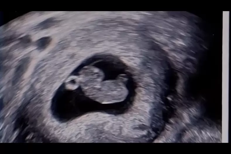 ecografie-fiica-eminem3