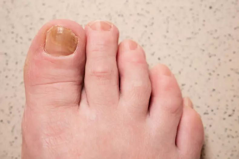 Toenails with fungal infection and bruise on big toe macro