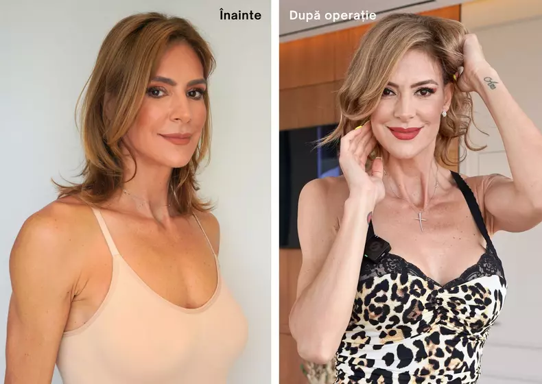 roxana-ciuhulescu-operatie-de-implant-si-lifting-mamar