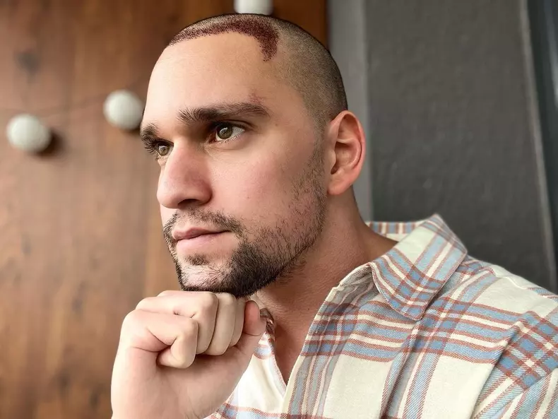 Vlad-Gherman-si-a-facut-implant-de-par-2