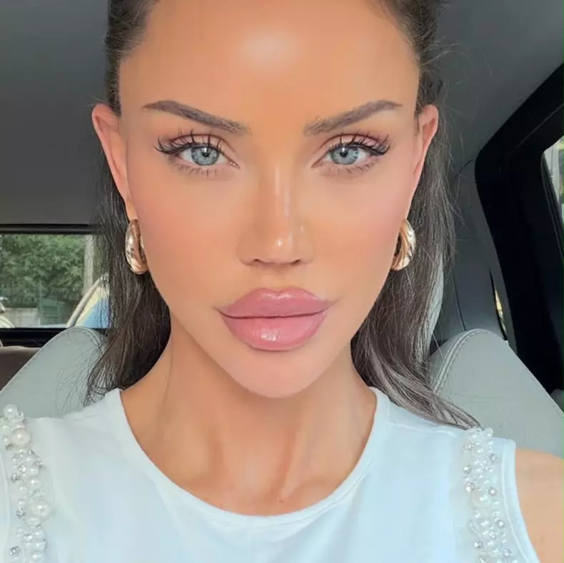 Bianca Drăgușanu otoplastie (3)