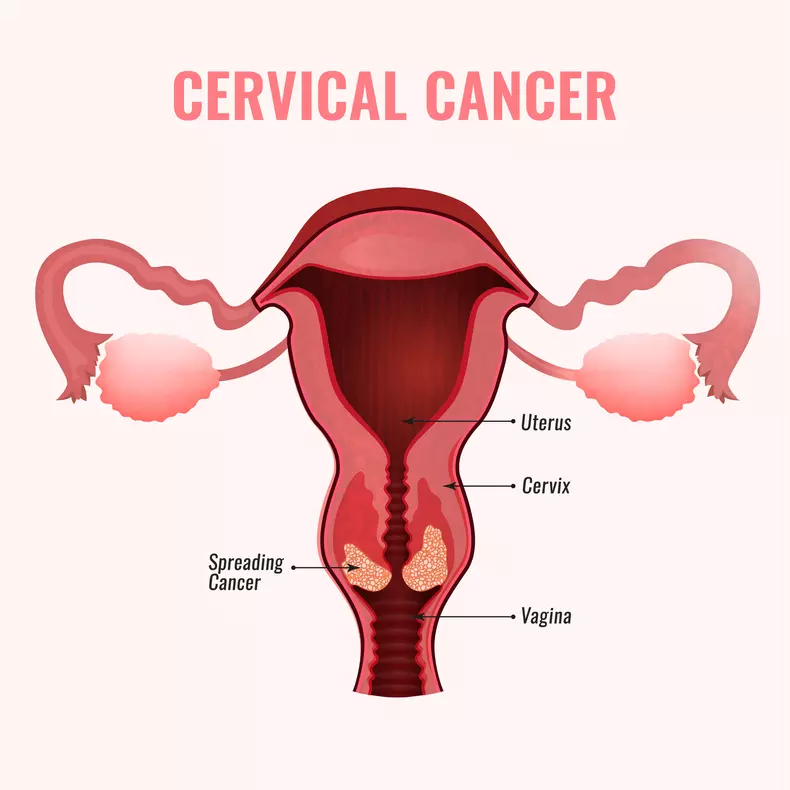 cancer de col uterin 1