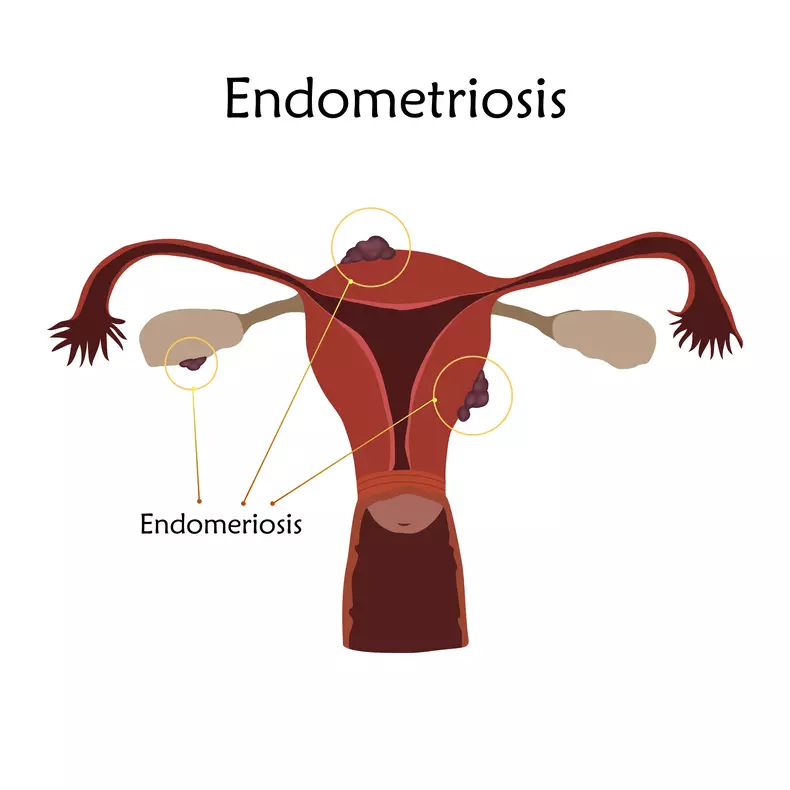 cancer de col uterin 2