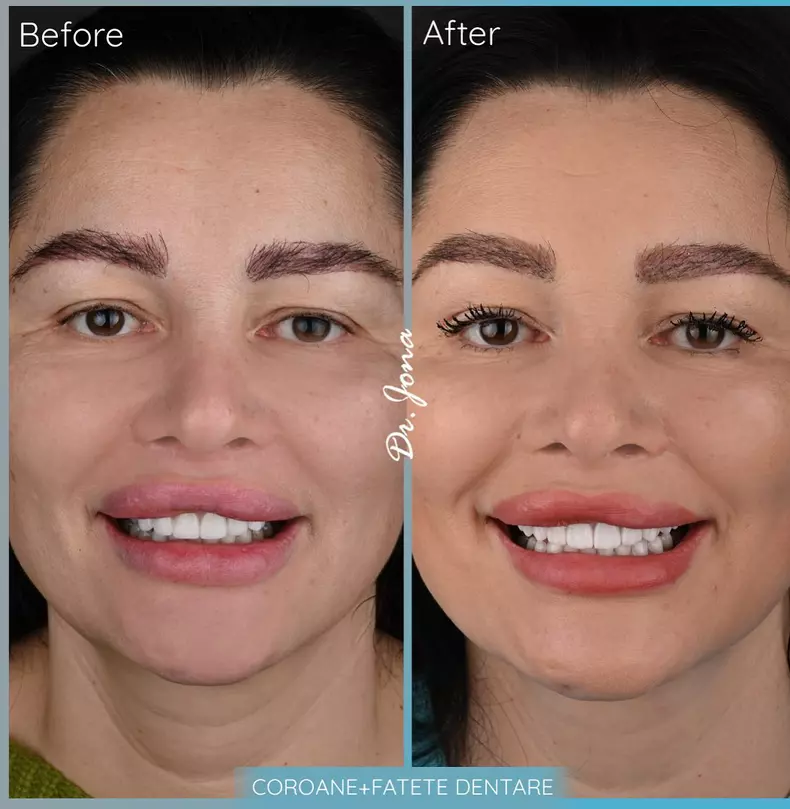 Brigitte-Pastrama-si-a-topit-acidul-din-buze-1