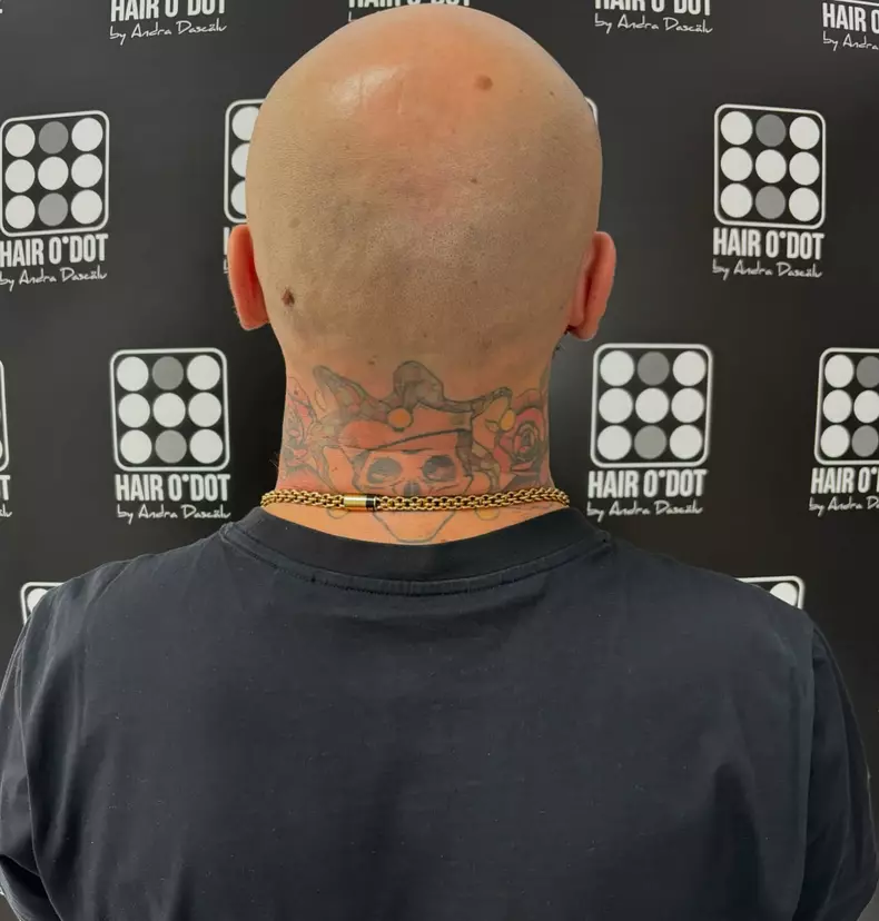 CRBL înainte de implant păr (2)