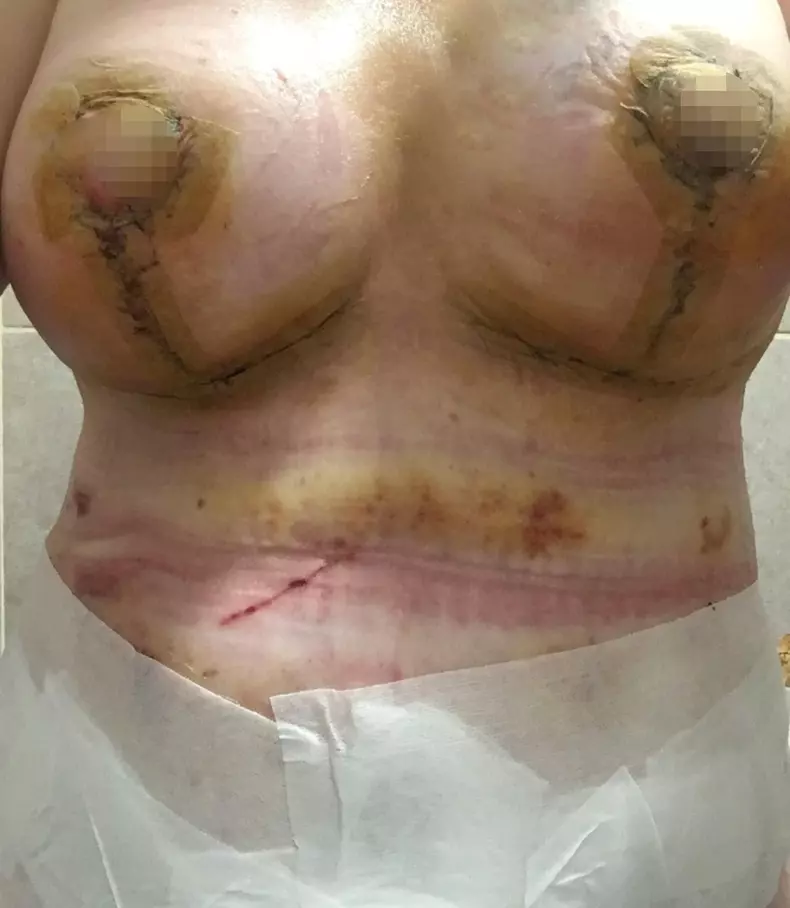 BOTCHED BOOB JOB