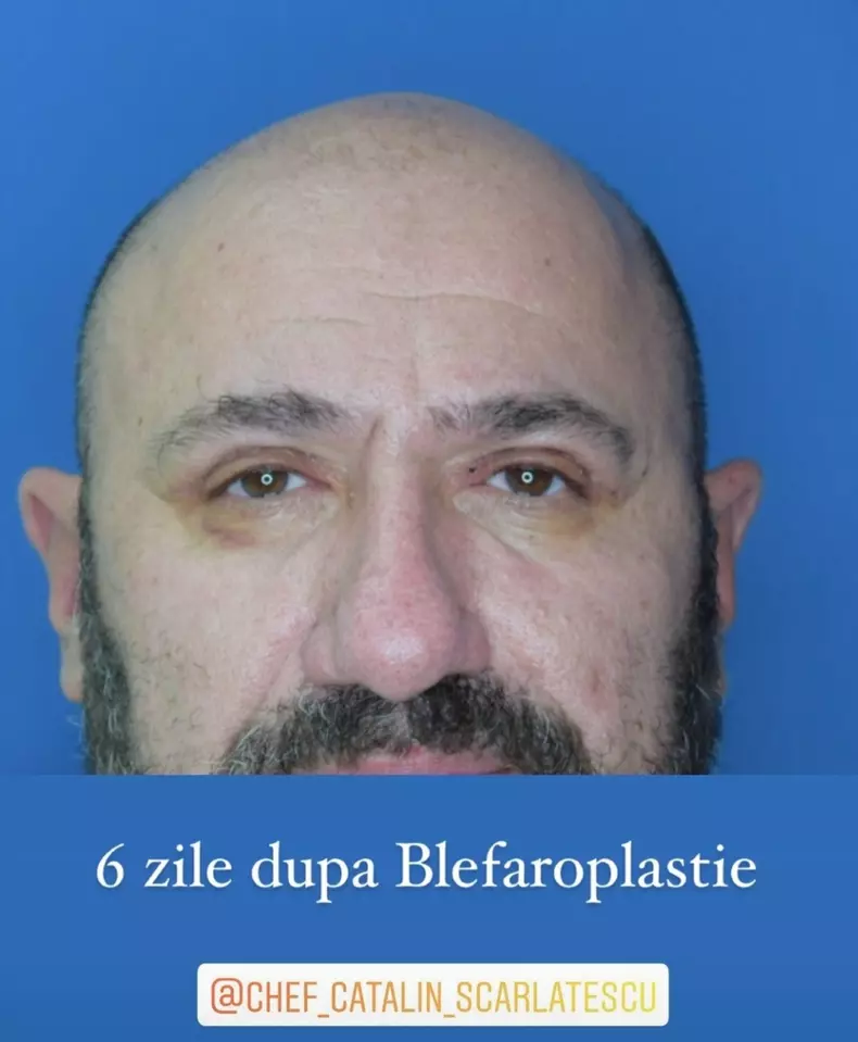 Chef Cătălin Scărlătescu blefaroplastie
