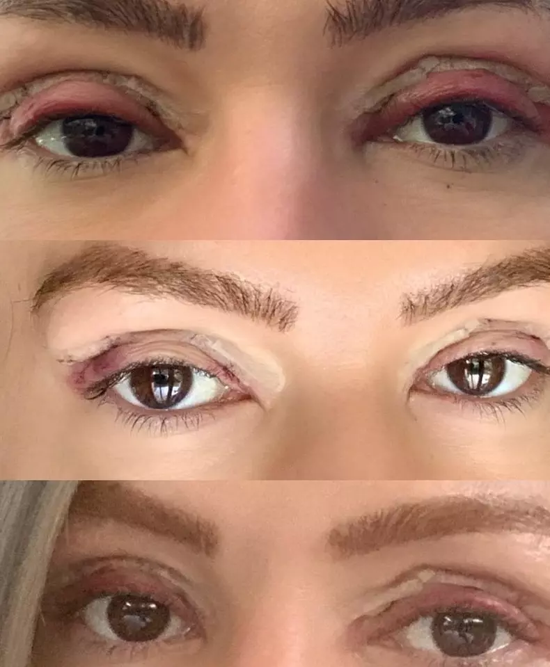 Roxana Ciuhulescu blefaroplastie