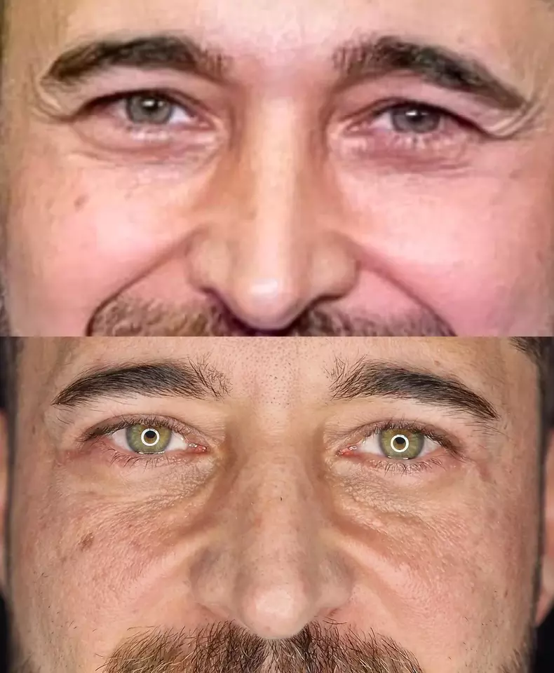 Dinu Maxer blefaroplastie